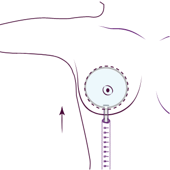 Illustrazione della tecnica Preservé: un palloncino gonfiabile allunga i tessuti e crea lo spazio per la protesi